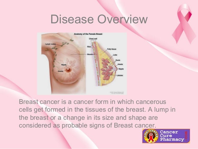 overview on breast cancer Overview on breast cancer